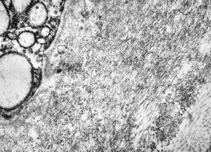 M,71y. | glandula vesiculosa - amyloid M,71y. | glandula vesiculosa - amyloid